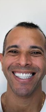 Depois — Harmonização do sorriso