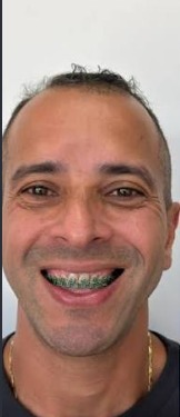 Antes — Harmonização do sorriso