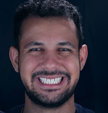 Depois — Clareamento dental
